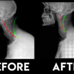 Chiropractic Adjustment